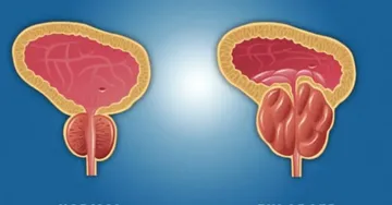 Kuna Aina Kama Tatu Hivi Za Magonjwa Hatari Ya Tezidume, ↳ Kukua kwa tezi dume, Hii sio Saratani wala bacteria infection, Kitaalamu hujulikana kama, 